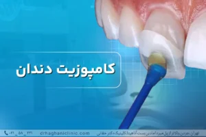 کامپوزیت دندان