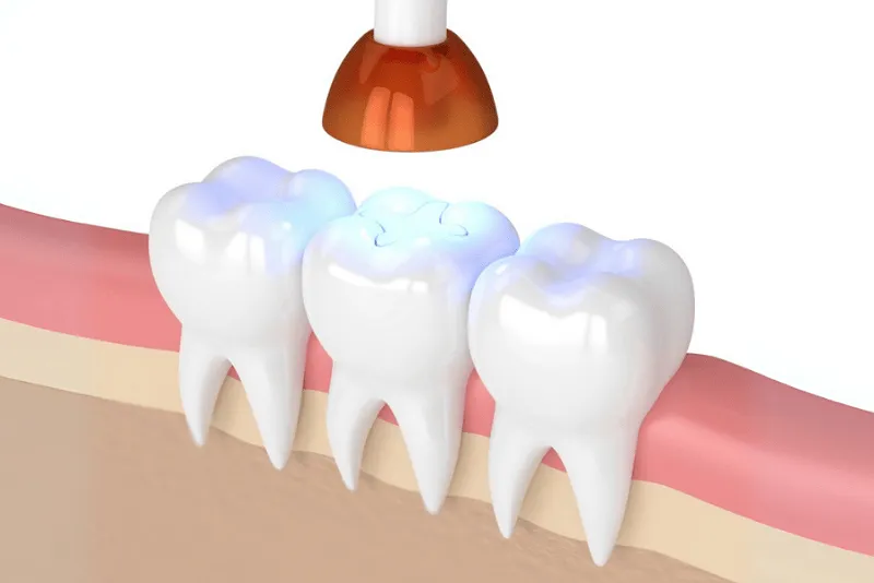 سفت شدن مواد با نور مخصوص