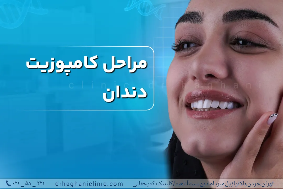 مراحل کامپوزیت دندان