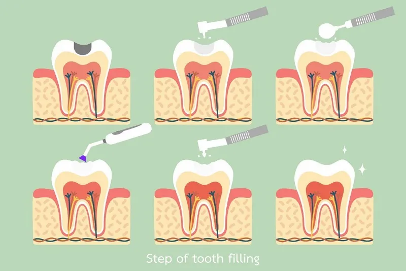 چرا کامپوزیت دندان؟
