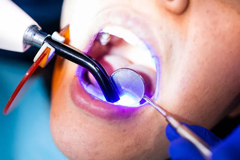 انواع کامپوزیت دندان بر اساس اندازه ذرات