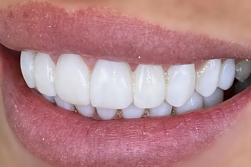 کاربردهای کامپوزیت زیبایی دندان