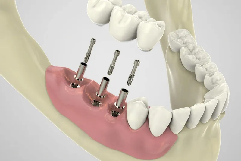 ایمپلنت بدون جراحی چیست؟