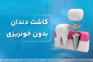 کاشت دندان بدون خونریزی