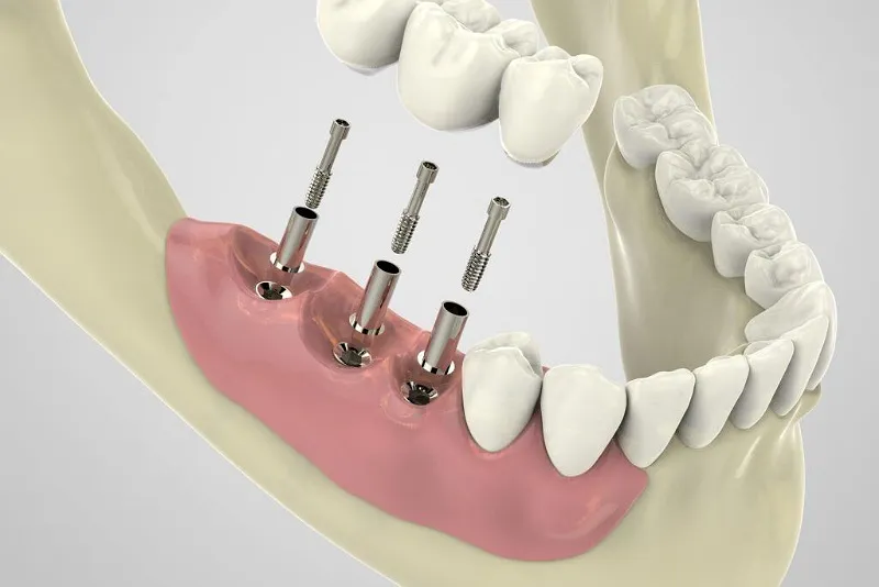 معرفی ایمپلنت اندواستیل