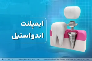 ایمپلنت اندواستیل