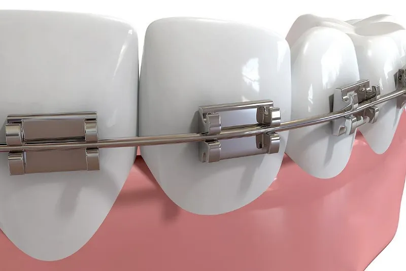 کاربردهای اصلی ارتودنسی سریع