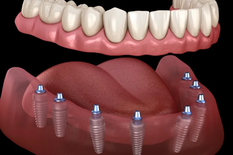 کاندید مناسب برای دندان مصنوعی ثابت