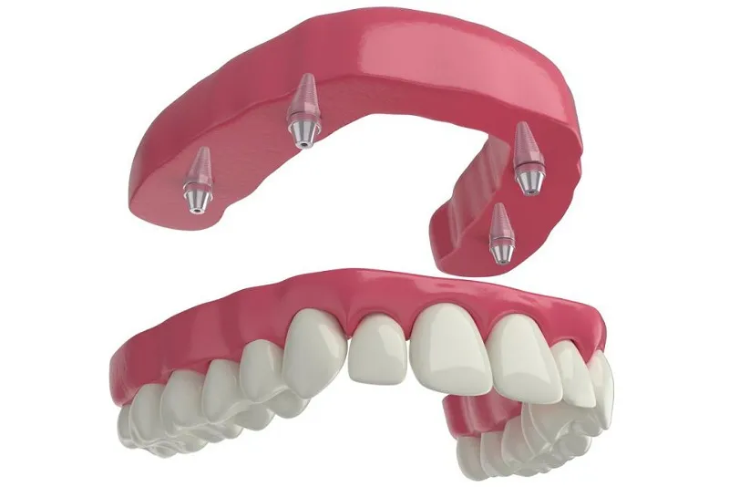 ایمپلنت فول فک؛ بازسازی کامل لبخند با تکنولوژی روز 