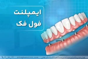 ایمپلنت فول فک