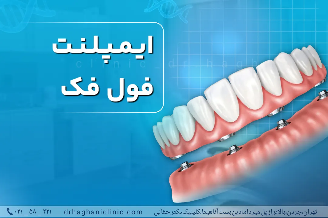 ایمپلنت فول فک