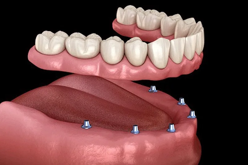 بازسازی کامل دندان با ایمپلنت فول فک دندان  
