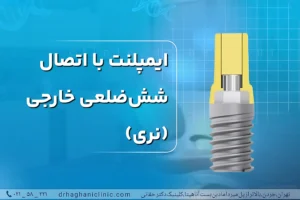 ایمپلنت با اتصال شش ضلعی خارجی (نری)