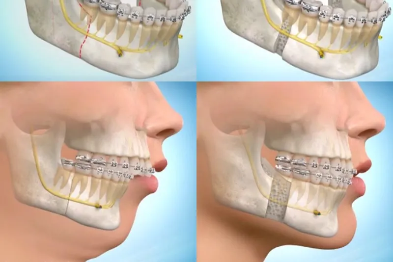جراحی فک برای ارتودنسی