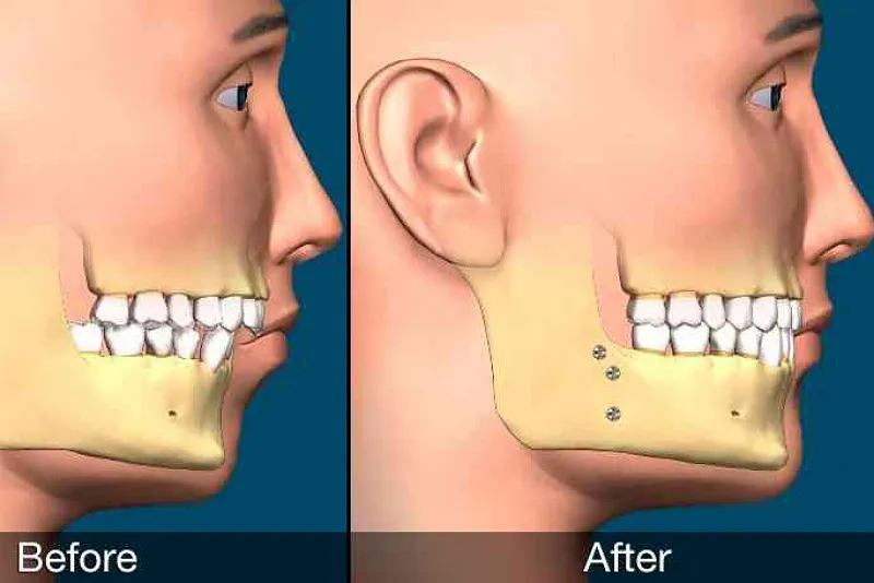 امکان انجام هم‌زمان ارتودنسی و جراحی فک