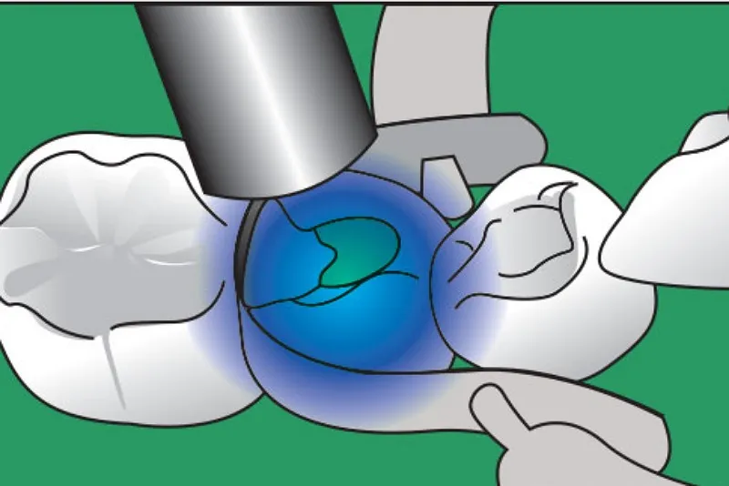 مشخصات فنی کامپوزیت میکروهیبرید Master Dent
