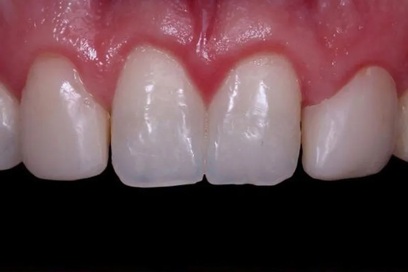 مزایای کامپوزیت میکروفیل