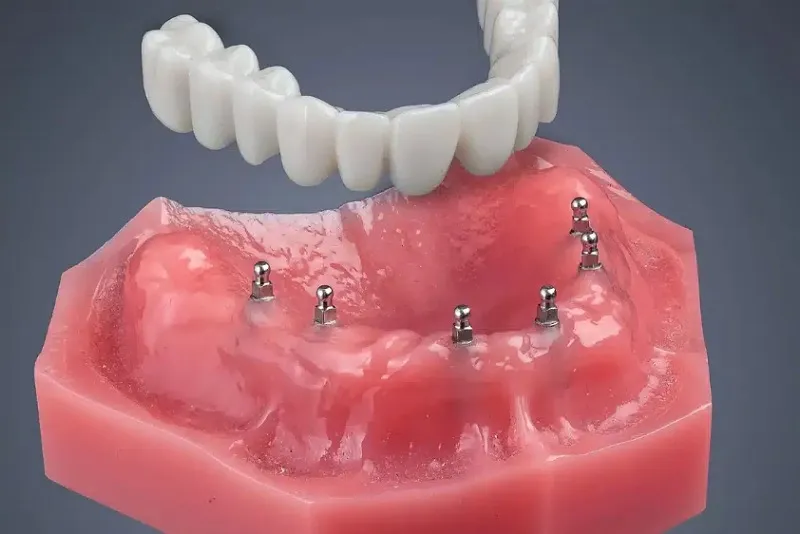 مینی ایمپلنت دندان