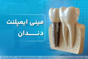 مینی ایمپلنت دندان