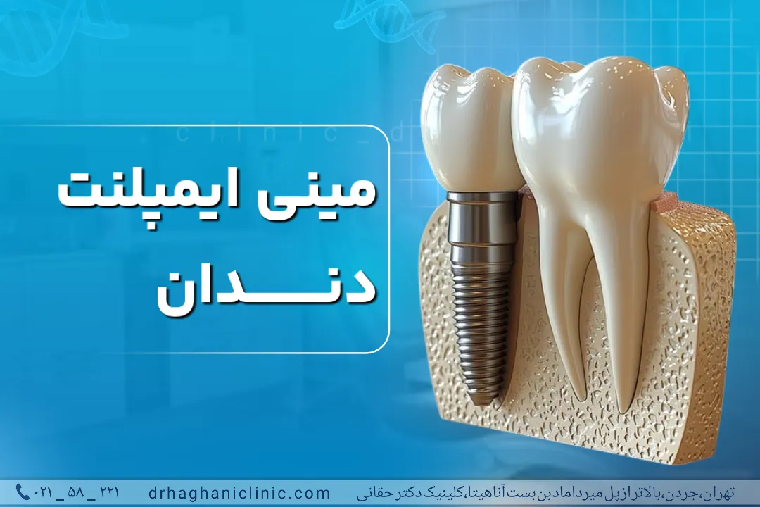 مینی ایمپلنت دندان
