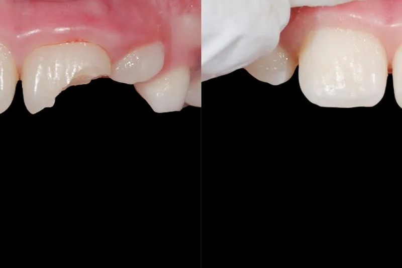 مراقبت های بعد ترمیم با نانو کامپوزیت