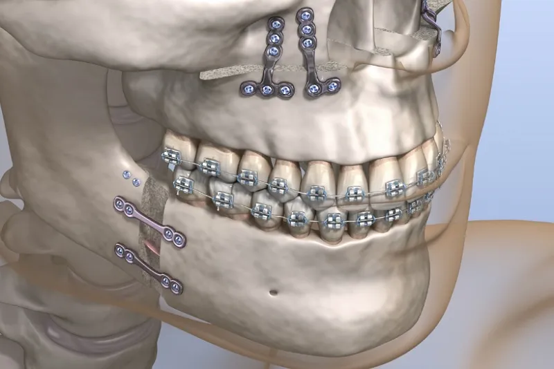 مراقبت‌های بعد از ارتوسرجری