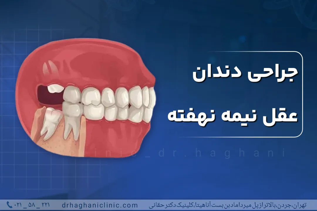جراحی دندان عقل نیمه نهفته