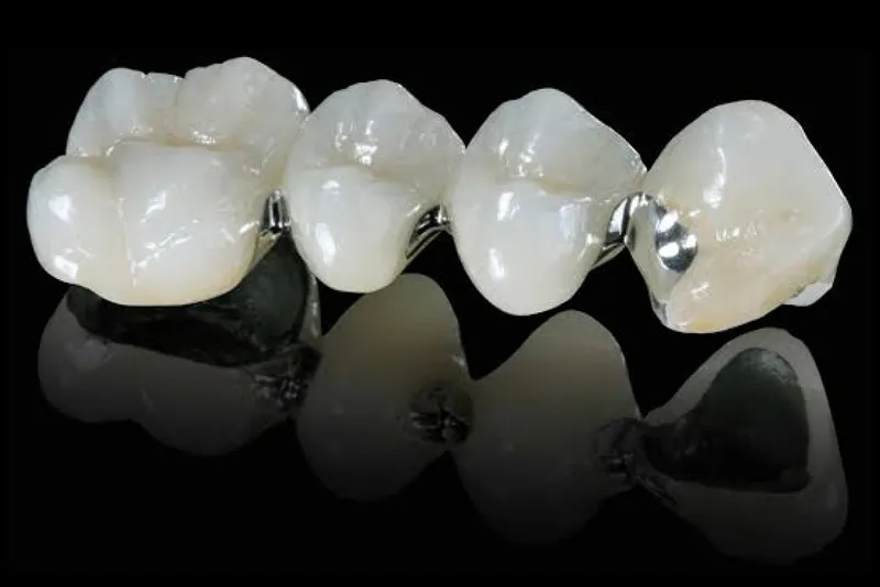 روکش پی اف ام (PFM)