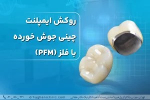 روکش ایمپلنت چینی جوش خورده با فلز (pfm)