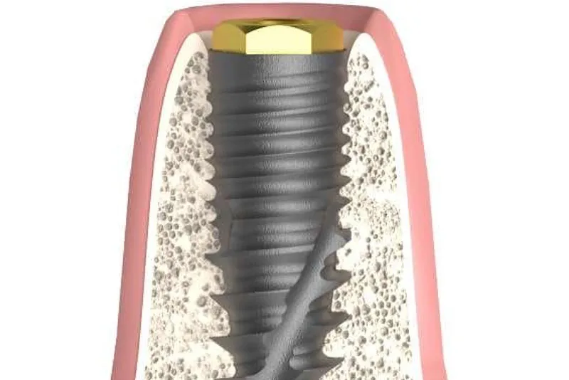 قطر انواع ایمپلنت دندان  