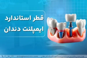قطر ایمپلنت دندان