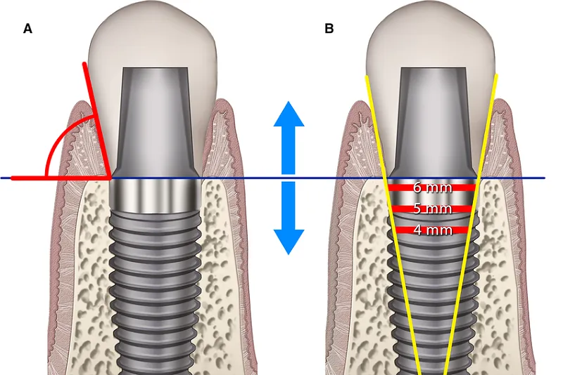 قطر استاندارد ایمپلنت دندان 