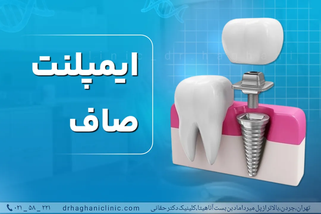 ایمپلنت دندان صاف