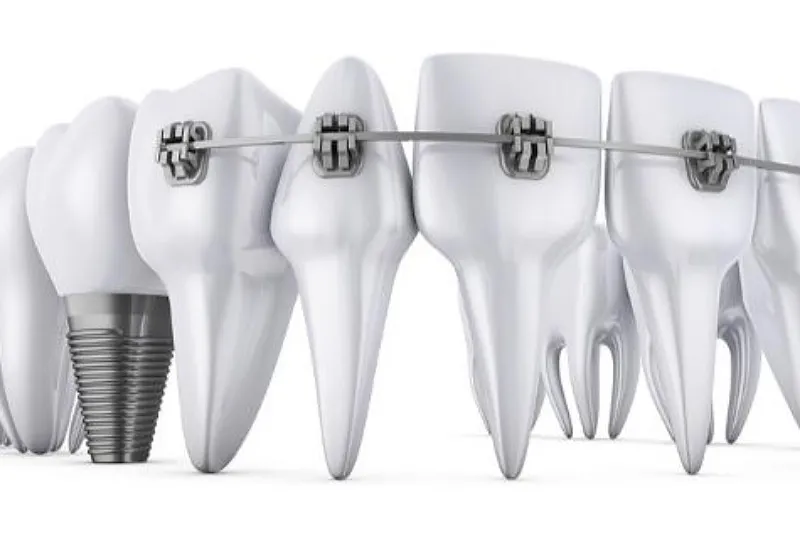 مراحل کاشت ایمپلنت دندان صاف