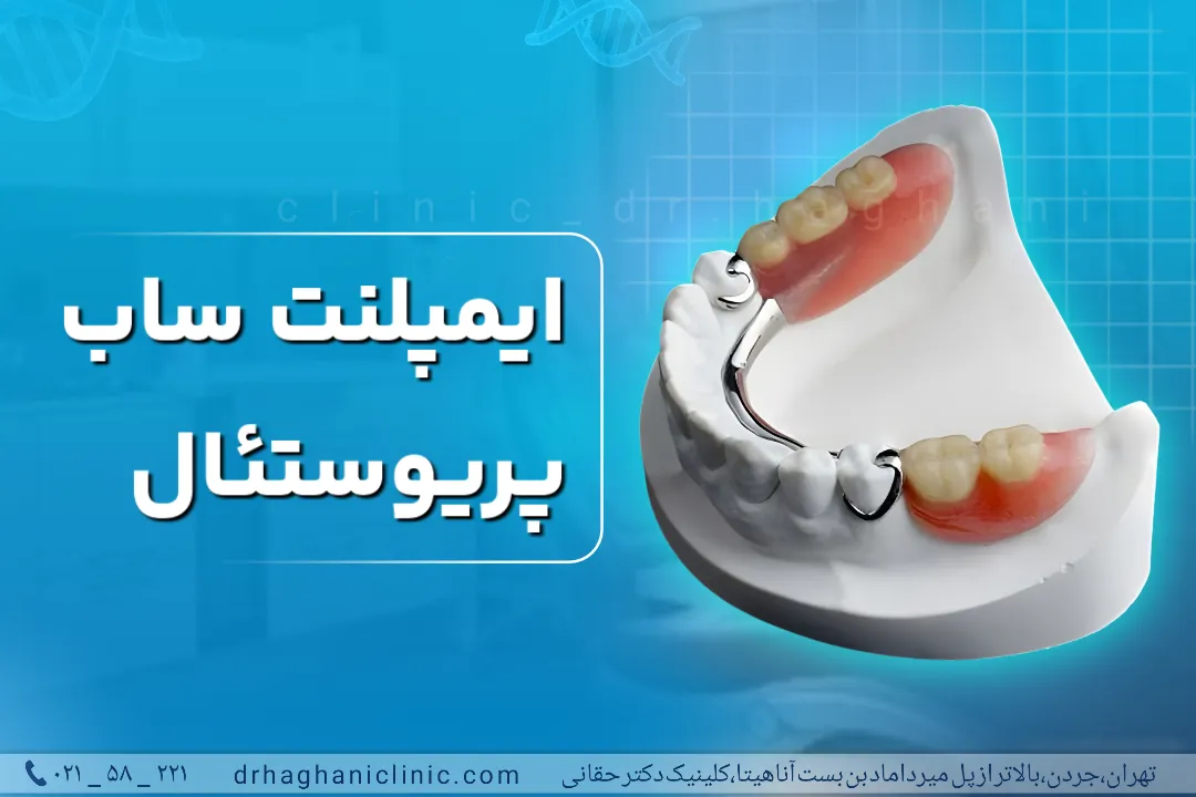 ایمپلنت ساب پریوستئال