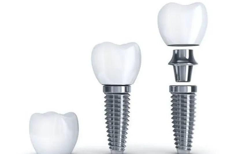 تیتانیوم برای ایمپلنت