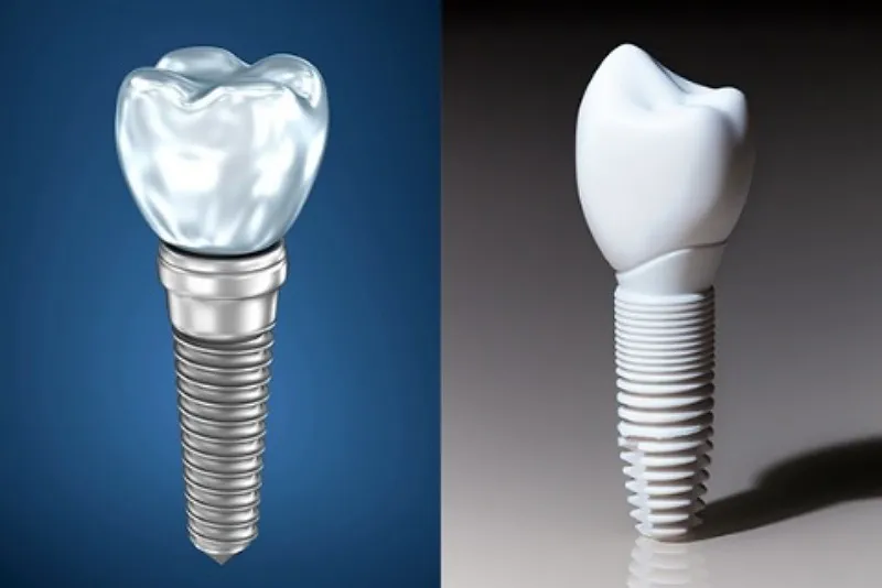 مقایسه ایمپلنت تیتانیومی و زیرکونیا