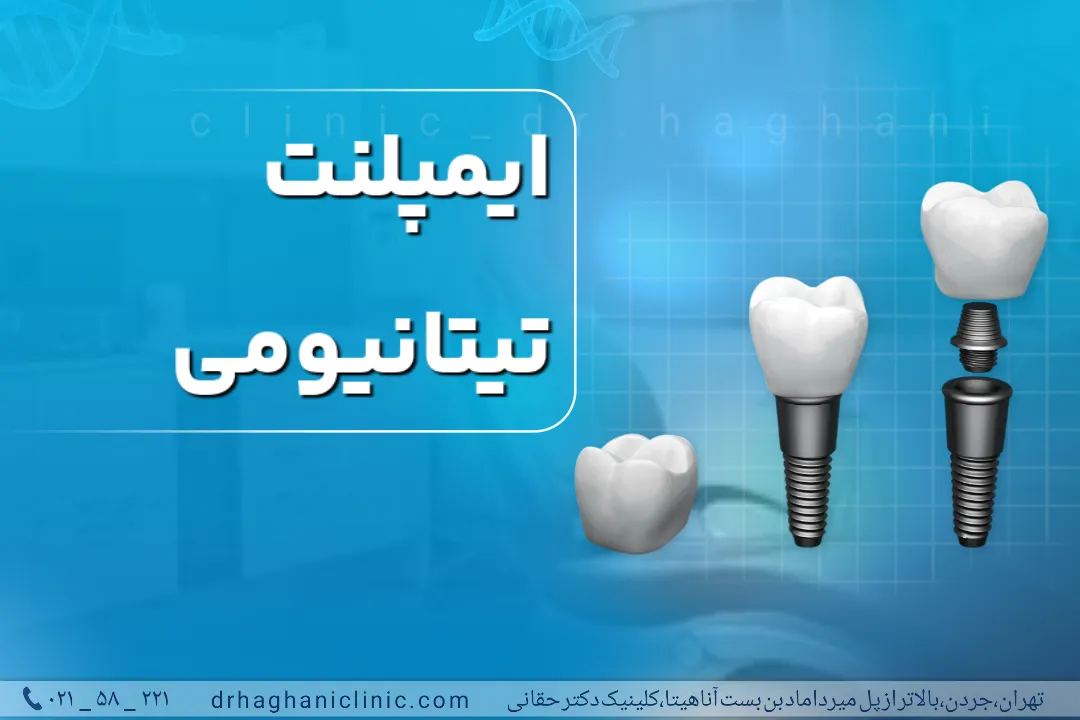 ایمپلنت تیتانیومی