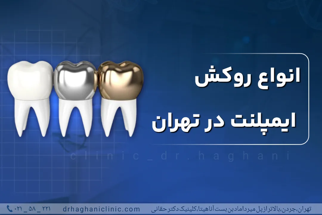 انواع روکش ایمپلنت در تهران