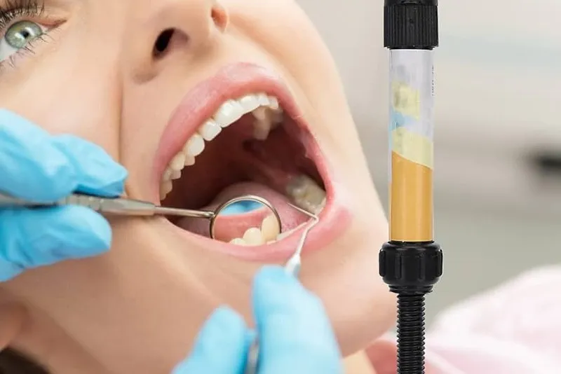 مزایای کامپوزیت یونیورسال