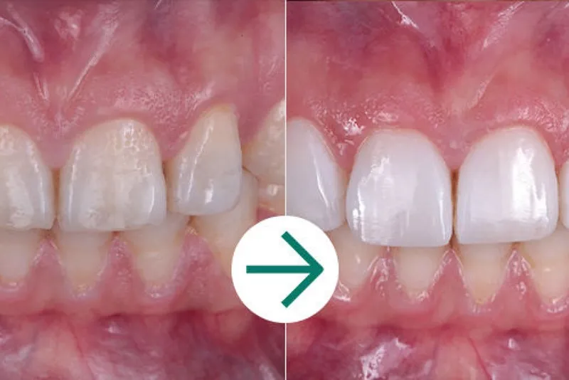 کامپوزیت یونیورسال