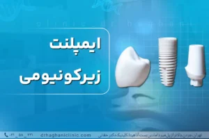 ایمپلنت زیرکونیومی