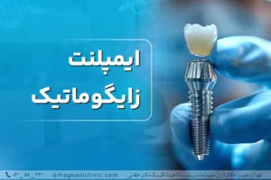 ایمپلنت زایگو ماتیک