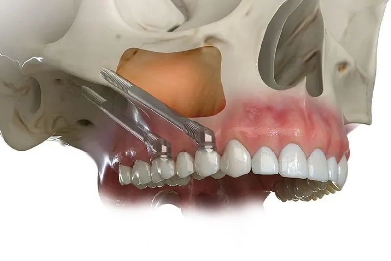 معرفی استخوان زیگوماتیک