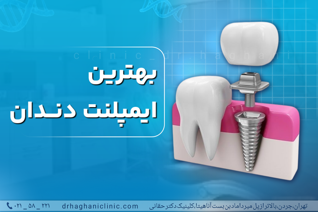 بهترین ایمپلنت دندان