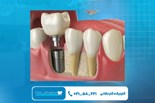 ایمپلنت بدون درد در تهران ایمپلنت بدون درد در تهران