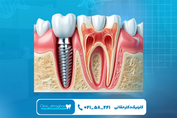 ایمپلنت بدون درد ایمپلنت بدون درد