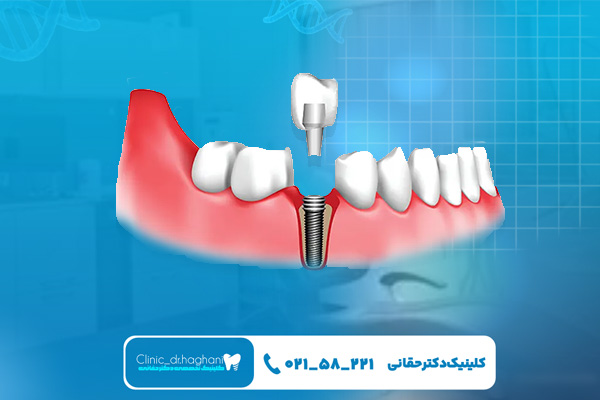 ایمپلنت بدون درد ایمپلنت بدون درد