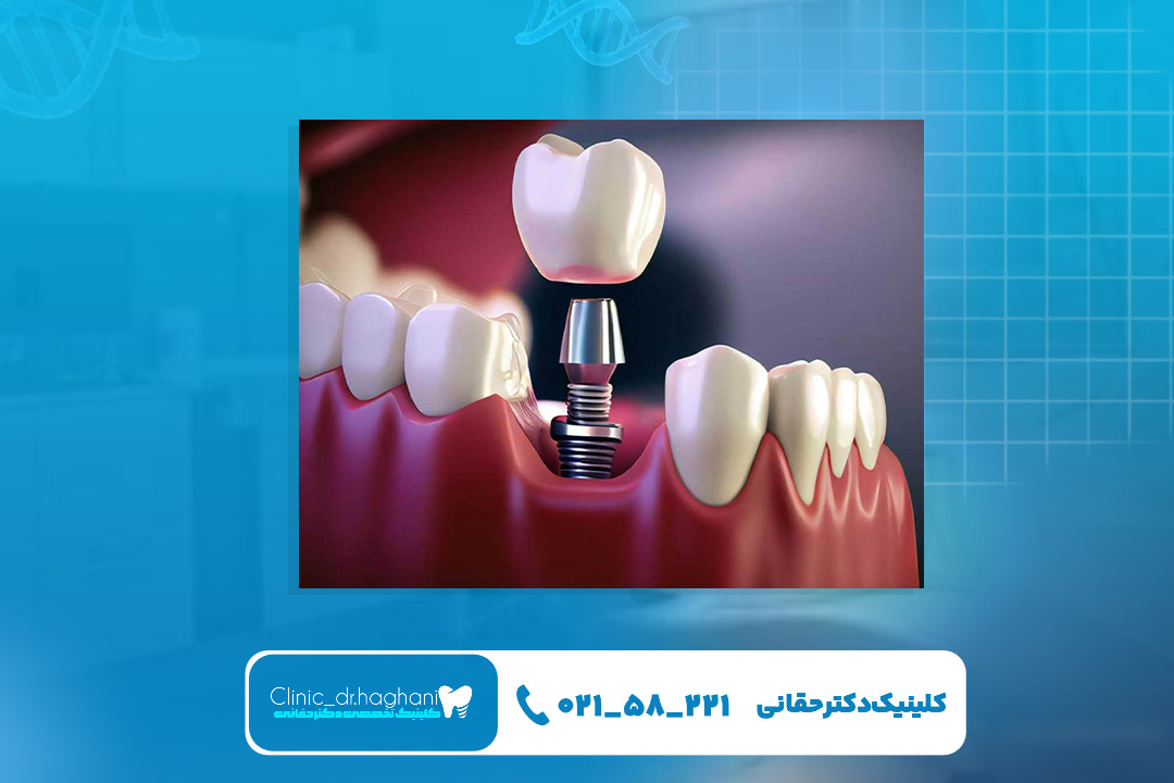 بهترین ایمپلنت دندان