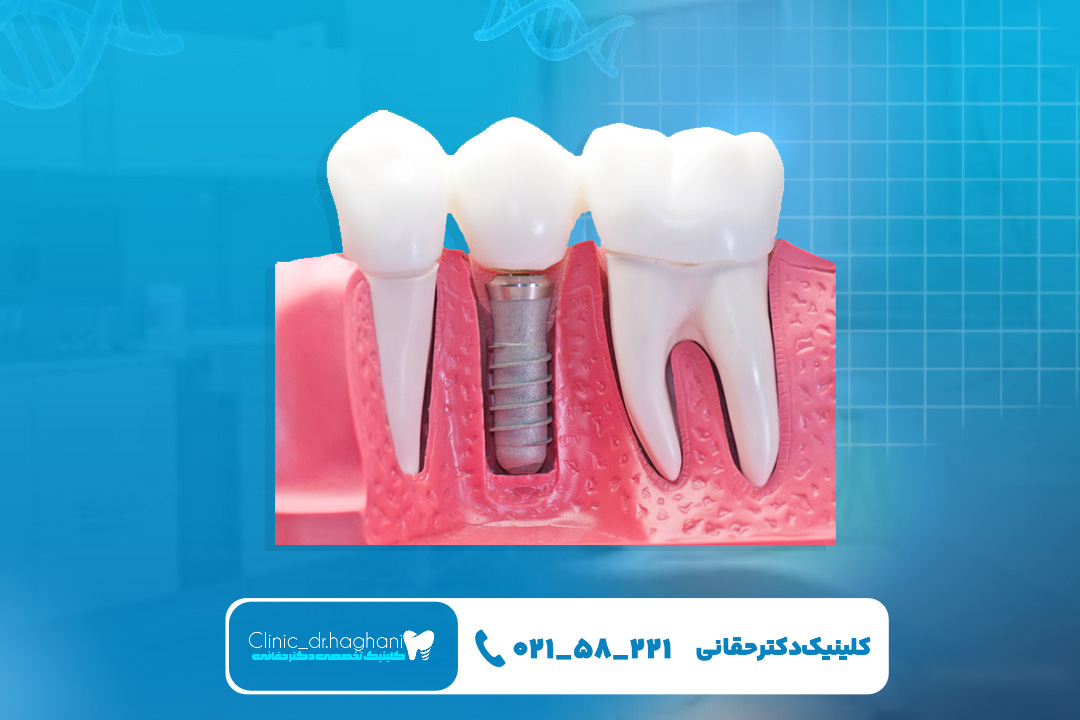 بهترین ایمپلنت دندان